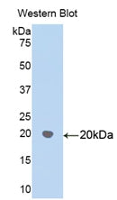 DAB staining on IHC-P; Samples: Human Glioma Tissue; Primary Ab: 30µg/ml Rabbit Anti-Human HSPD1 Antibody Second Ab: 2µg/mL HRP-Linked Caprine Anti-Rabbit IgG Polyclonal Antibody
