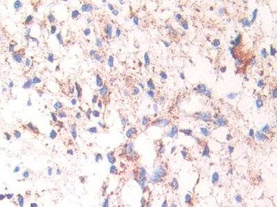DAB staining on IHC-P; Samples: Human Stomach Cancer Tissue.