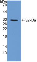 DAB staining on IHC-P; Samples: Human Prostate cancer Tissue; Primary Ab: 10µg/ml Rabbit Anti-Human FUCa1 Antibody Second Ab: 2µg/mL HRP-Linked Caprine Anti-Rabbit IgG Polyclonal Antibody