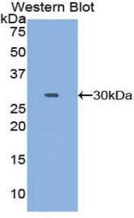 DAB staining on IHC-P; Samples: Human Endometrial cancer Tissue; Primary Ab: 10µg/ml Rabbit Anti-Human TOP2 Antibody Second Ab: 2µg/mL HRP-Linked Caprine Anti-Rabbit IgG Polyclonal Antibody