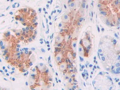 DAB staining on IHC-P; Samples: Human Stomach cancer Tissue)
