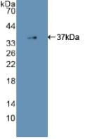 DAB staining on IHC-P; Samples: Human Glioma Tissue; Primary Ab: 30µg/ml Rabbit Anti-Human EGFR Antibody Second Ab: 2µg/mL HRP-Linked Caprine Anti-Rabbit IgG Polyclonal Antibody