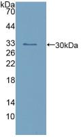 DAB staining on IHC-P; Samples: Human Skin cancer Tissue; Primary Ab: 10µg/ml Rabbit Anti-Human CR Antibody Second Ab: 2µg/mL HRP-Linked Caprine Anti-Rabbit IgG Polyclonal Antibody