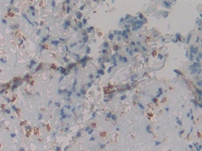 DAB staining on IHC-P; Samples: Human Rectum Cancer Tissue.
