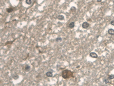 DAB staining on IHC-P; Samples: Human Prostate cancer Tissue)