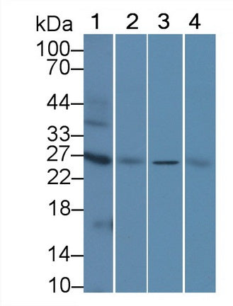 DAB staining on IHC-P; Samples: Human Glioma Tissue; Primary Ab: 10µg/ml Rabbit Anti-Human AQP1 Antibody Second Ab: 2µg/mL HRP-Linked Caprine Anti-Rabbit IgG Polyclonal Antibody