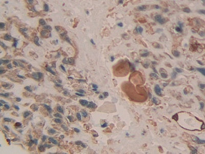 DAB staining on IHC-P;;Samples: Human Prostate Gland Tissue.