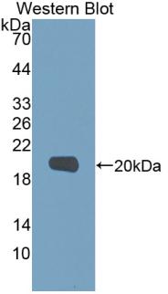 DAB staining on IHC-P; Samples: Human Lung cancer Tissue; Primary Ab: 20µg/ml Rabbit Anti-Human MMP9 Antibody Second Ab: 2µg/mL HRP-Linked Caprine Anti-Rabbit IgG Polyclonal Antibody