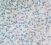 DAB staining on IHC-P; Samples: Human Rectum Cancer Tissue.