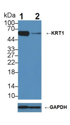DAB staining on IHC-P; Samples: Human Breast cancer Tissue; Primary Ab: 10µg/ml Rabbit Anti-Human KRT1 Antibody Second Ab: 2µg/mL HRP-Linked Caprine Anti-Rabbit IgG Polyclonal Antibody