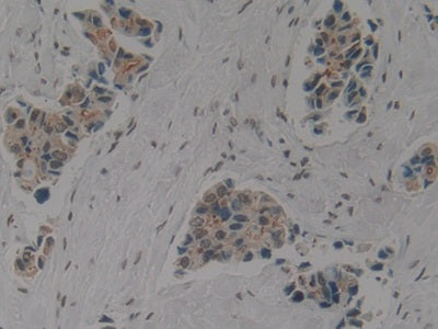 DAB staining on IHC-P; Samples: Human Liver Cancer Tissue.