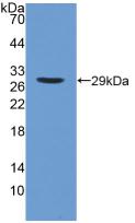 DAB staining on IHC-P; Samples: Human Pancreatic cancer Tissue; Primary Ab: 10µg/ml Rabbit Anti-Human iPLA2 Antibody Second Ab: 2µg/mL HRP-Linked Caprine Anti-Rabbit IgG Polyclonal Antibody