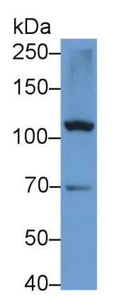 DAB staining on IHC-P; Samples: Human Liver cancer Tissue;  Primary Ab: 20µg/ml Rabbit Anti-Human MY