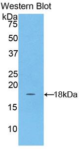 DAB staining on IHC-P; Samples: Human Breast cancer Tissue; Primary Ab: 20µg/ml Rabbit Anti-Human ACP Antibody Second Ab: 2µg/mL HRP-Linked Caprine Anti-Rabbit IgG Polyclonal Antibody