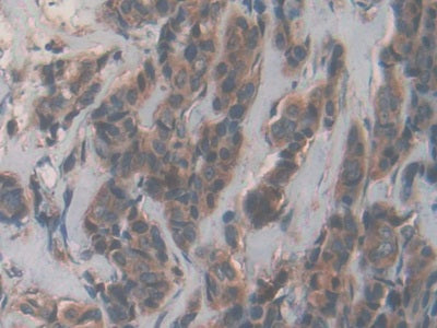 DAB staining on IHC-P; Samples: Human Liver Cancer Tissue.
