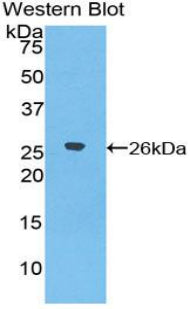 DAB staining on IHC-P; Samples: Human Breast cancer Tissue; Primary Ab: 20µg/ml Rabbit Anti-Human TFR2 Antibody Second Ab: 2µg/mL HRP-Linked Caprine Anti-Rabbit IgG Polyclonal Antibody