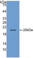 DAB staining on IHC-P; Samples: Human Liver cancer Tissue; Primary Ab: 20µg/ml Rabbit Anti-Human ADM Antibody Second Ab: 2µg/mL HRP-Linked Caprine Anti-Rabbit IgG Polyclonal Antibody