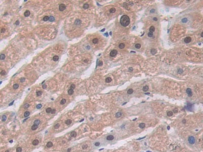 DAB staining on IHC-P; Samples: Human Breast Cancer Tissue