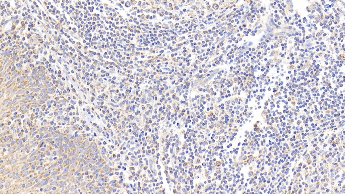 DAB staining on IHC-P; Samples: Human Ovarian cancer Tissue;  Primary Ab: 20μg/ml Rabbit Anti-Human PTGES Antibody Second Ab: 2µg/mL HRP-Linked Caprine Anti-Rabbit IgG Polyclonal Antibody