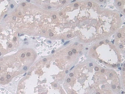 DAB staining on IHC-P; Samples: Human Liver Cancer Tissue.