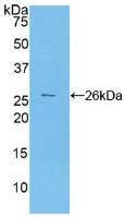 DAB staining on IHC-P; Samples: Human Breast cancer Tissue; Primary Ab: 10µg/ml Rabbit Anti-Human CA125 Antibody Second Ab: 2µg/mL HRP-Linked Caprine Anti-Rabbit IgG Polyclonal Antibody
