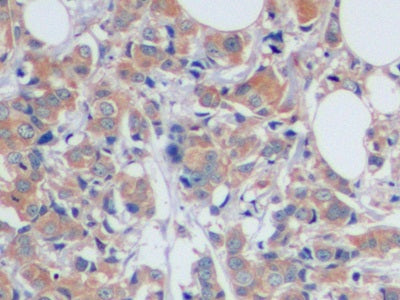 DAB staining on IHC-P; Samples: Human Liver Cancer Tissue