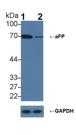 DAB staining on IHC-P; Samples: Human Liver cancer Tissue; Primary Ab: 20µg/ml Rabbit Anti-Human aFP Antibody Second Ab: 2µg/mL HRP-Linked Caprine Anti-Rabbit IgG Polyclonal Antibody