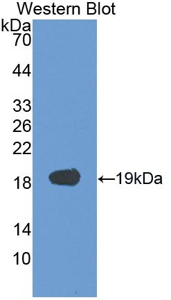 DAB staining on IHC-P; Samples: Human Glioma Tissue; Primary Ab: 30µg/ml Rabbit Anti-Human VEGFA Antibody Second Ab: 2µg/mL HRP-Linked Caprine Anti-Rabbit IgG Polyclonal Antibody
