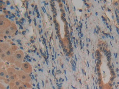 DAB staining on IHC-P; Samples: Human Liver Cancer Tissue.