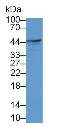 DAB staining on IHC-P; Samples: Human Liver cancer Tissue; Primary Ab: 20µg/ml Rabbit Anti-Human FASL Antibody Second Ab: 2µg/mL HRP-Linked Caprine Anti-Rabbit IgG Polyclonal Antibody
