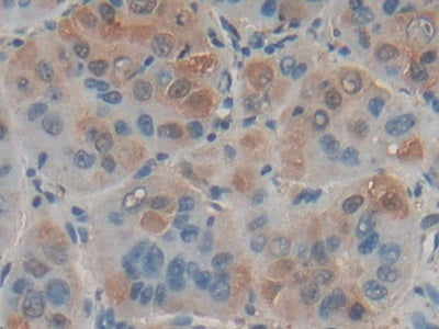 DAB staining on IHC-P; Samples: Human Rectum Cancer Tissue