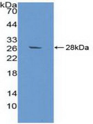 DAB staining on IHC-P; Samples: Human Prostate cancer Tissue; Primary Ab: 10µg/ml Rabbit Anti-Human aZGP1 Antibody Second Ab: 2µg/mL HRP-Linked Caprine Anti-Rabbit IgG Polyclonal Antibody