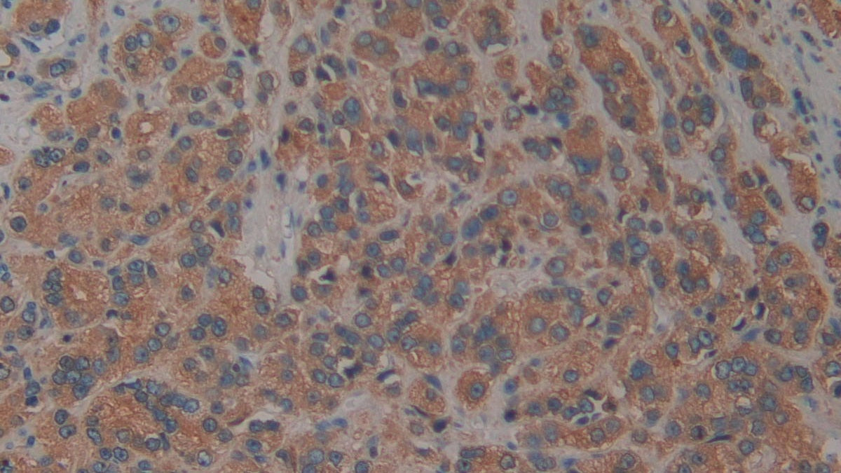DAB staining on IHC-P; Samples：.Human Breast Cancer Tissue.