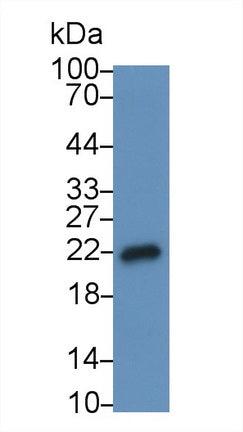 DAB staining on IHC-P; Samples: Human Colorectal cancer Tissue;  Primary Ab: 20µg/ml Mouse Anti-Huma