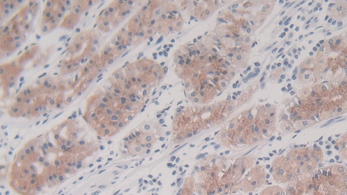 Figure.DAB staining on IHC-P<br/>Samples:Human Glioma Tissue