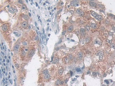 DAB staining on IHC-P; Samples: Human Breast cancer Tissue)