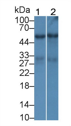DAB staining on IHC-P; Samples: Human Liver cancer Tissue; Primary Ab: 30µg/ml Mouse Anti-Human ALT Antibody Second Ab: 2µg/mL HRP-Linked Caprine Anti-Mouse IgG Polyclonal Antibody