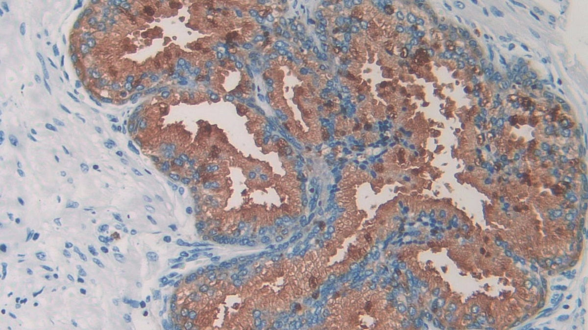 Figure. DAB staining on IHC-P; Samples: Human Rectum Cancer Tissue.