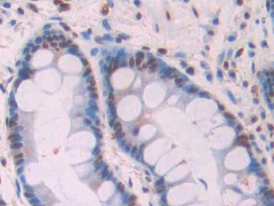 DAB staining on IHC-P; Samples: Human Stomach Cancer Tissue