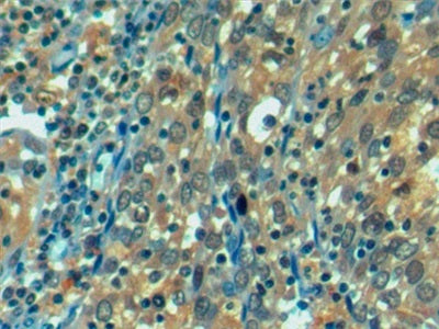 DAB staining on IHC-P; Samples: Human Endometrial cancer Tissue)