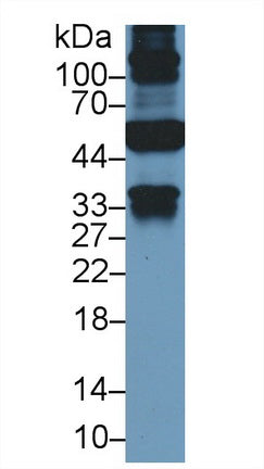 DAB staining on IHC-P; Samples: Human Breast cancer Tissue; Primary Ab: 10µg/ml Mouse Anti-Human KRT18 Antibody Second Ab: 2µg/mL HRP-Linked Caprine Anti-Mouse IgG Polyclonal Antibody