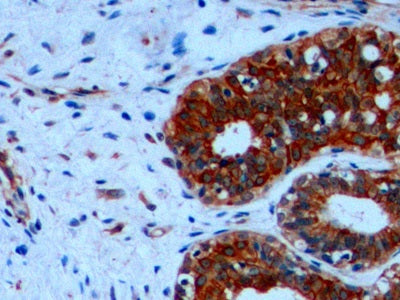 DAB staining on IHC-P; Samples: Human Endometrial cancer Tissue; Primary Ab: 10µg/ml Mouse Anti-Human KRT18 Antibody Second Ab: 2µg/mL HRP-Linked Caprine Anti-Mouse IgG Polyclonal Antibody