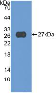 DAB staining on IHC-P; Samples: Human Skin cancer Tissue; Primary Ab: 30µg/ml Mouse Anti-Human ADAM17 Antibody Second Ab: 2µg/mL HRP-Linked Caprine Anti-Mouse IgG Polyclonal Antibody
