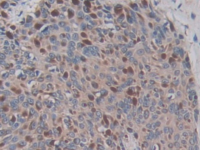 DAB staining on IHC-P; Samples: Human Cerebrum Tissue; Primary Ab: 30µg/ml Mouse Anti-Human ADAM17 Antibody Second Ab: 2µg/mL HRP-Linked Caprine Anti-Mouse IgG Polyclonal Antibody