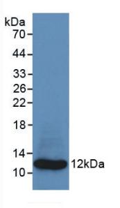 DAB staining on IHC-P; Samples: Human Renal cancer Tissue;  Primary Ab: 20µg/ml Mouse Anti-Human S10