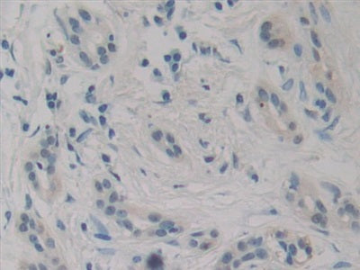 DAB staining on IHC-P; Samples: Human Pancreas Cancer Tissue