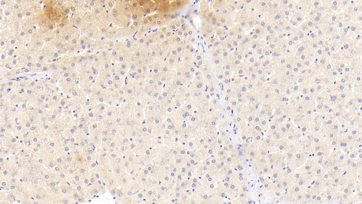 DAB staining on IHC-P;Samples:Human Pancreas Cancer Tissue)