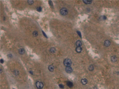 DAB staining on IHC-P; Samples: Human Pancreas Cancer Tissue.