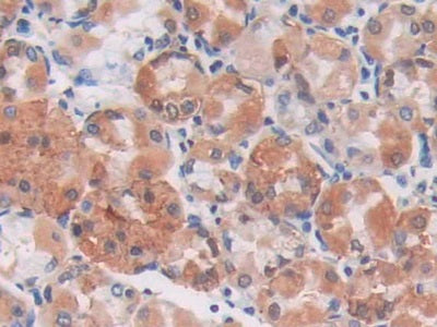 DAB staining on IHC-P;;Samples: Human Stomach Cancer Tissue