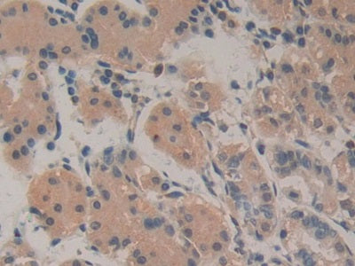 DAB staining on IHC-P; Samples: Human Pancreas Cancer Tissue.